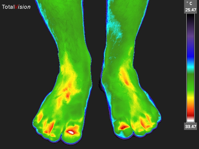 Thermal image of feet.